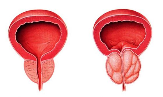 Prostate normale et enflammée (prostatite)